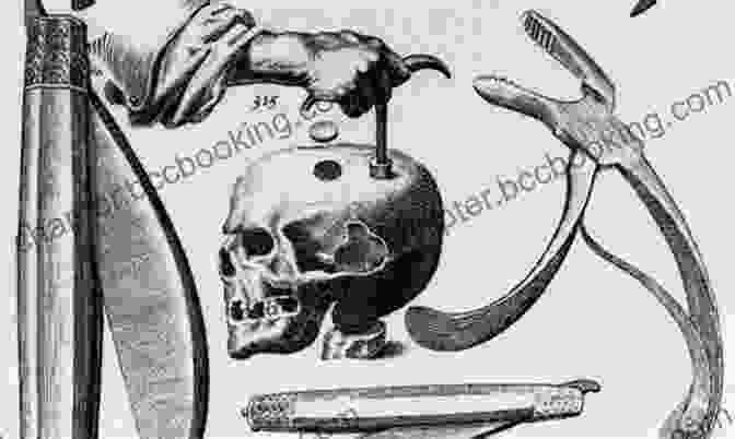 Trepanation, The Practice Of Drilling Holes In The Skull, Has Been Documented In Cultures Across The Globe For Thousands Of Years. Strange Medicine: A Shocking History Of Real Medical Practices Through The Ages